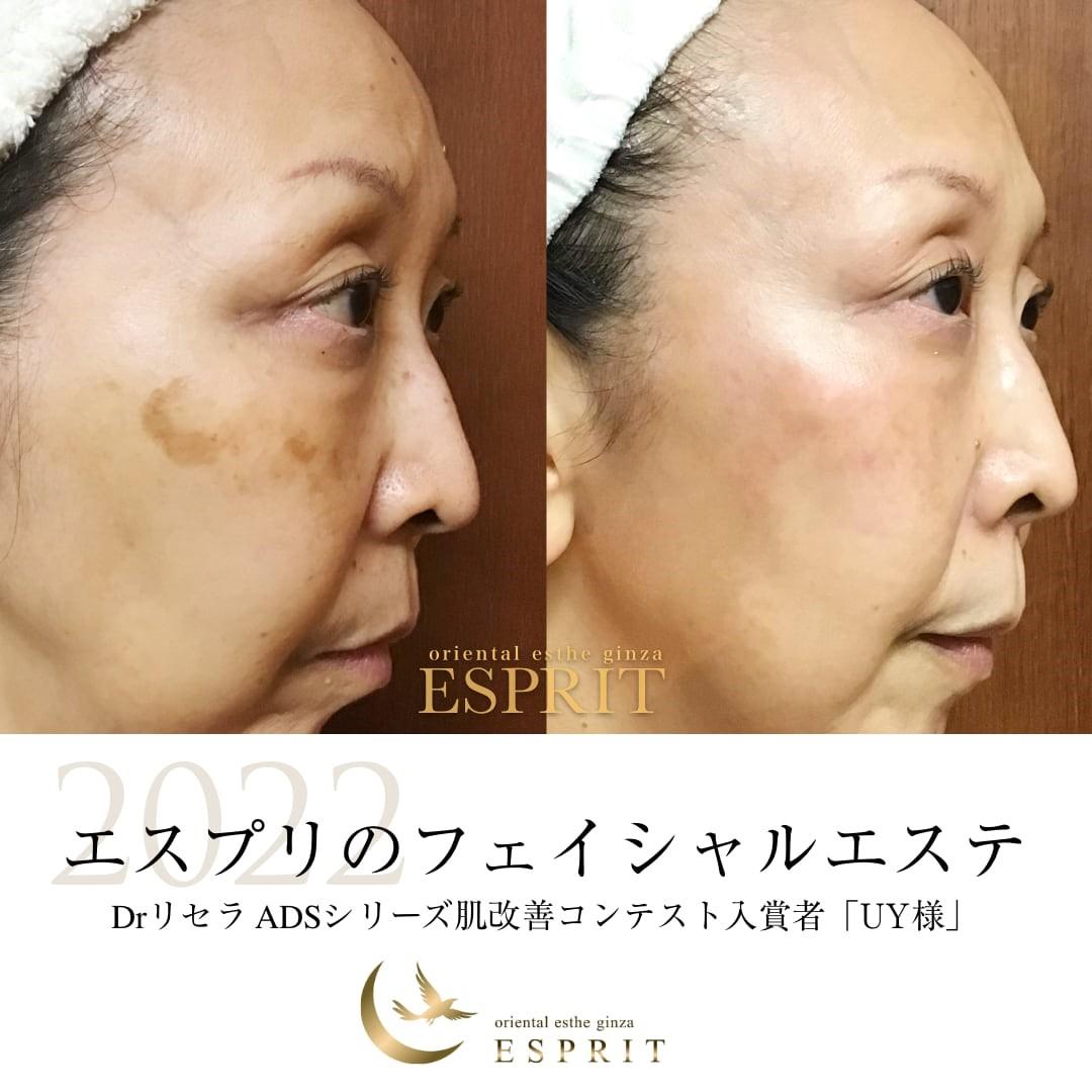 ドクターリセラ＋ごっそり毛穴小顔リフトアップ美顔 ｜東京銀座、新宿