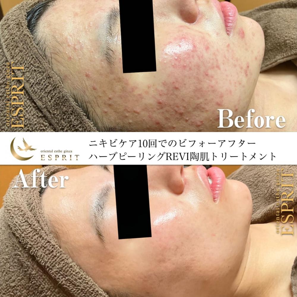 もう夏の肌荒れで悩まない！ピーリングで夏の肌トラブル解消！事例紹介