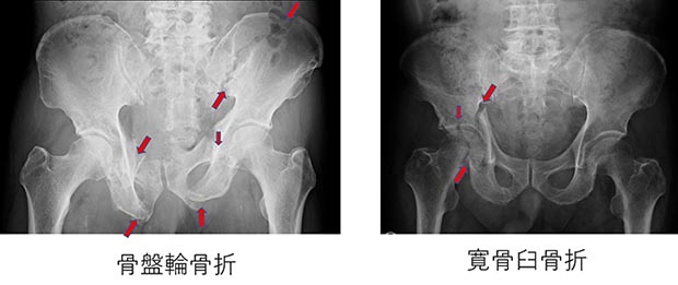 高齢者の骨盤骨折｜一般社団法人 日本整形外傷学会 骨折の解説
