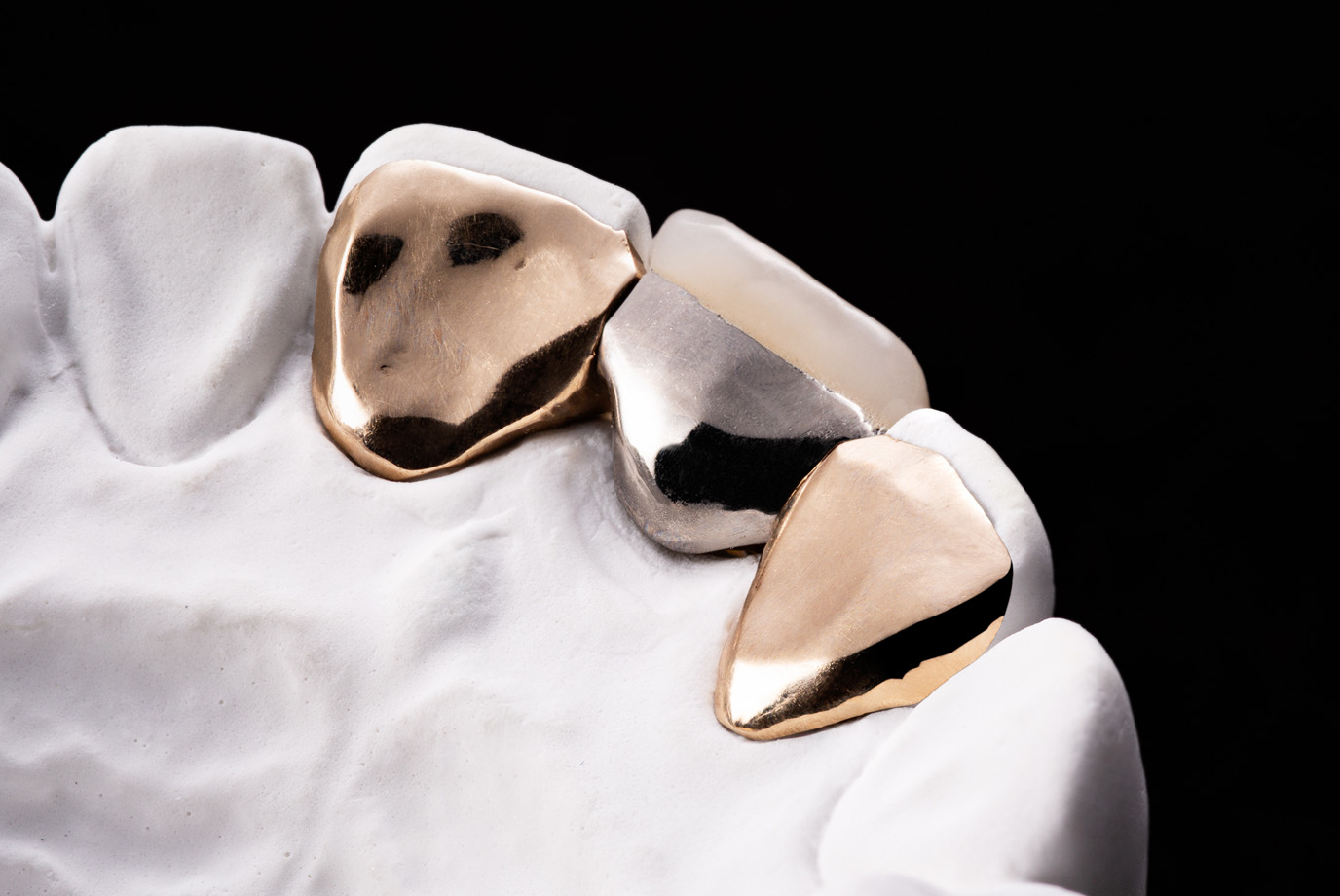 審美補綴物［MIブリッジ］｜株式会社シケン