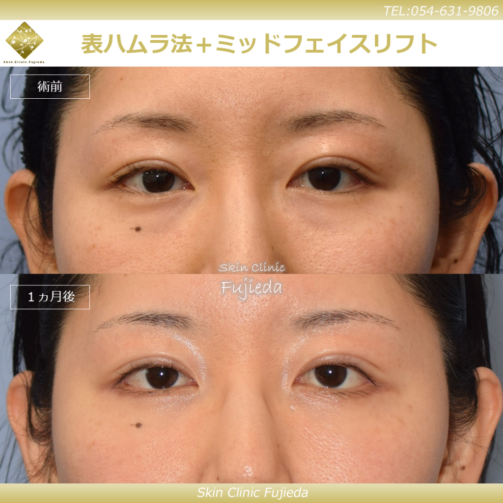二重全切開法 | 静岡の美容皮膚科・美容外科ならスキンクリニック藤枝