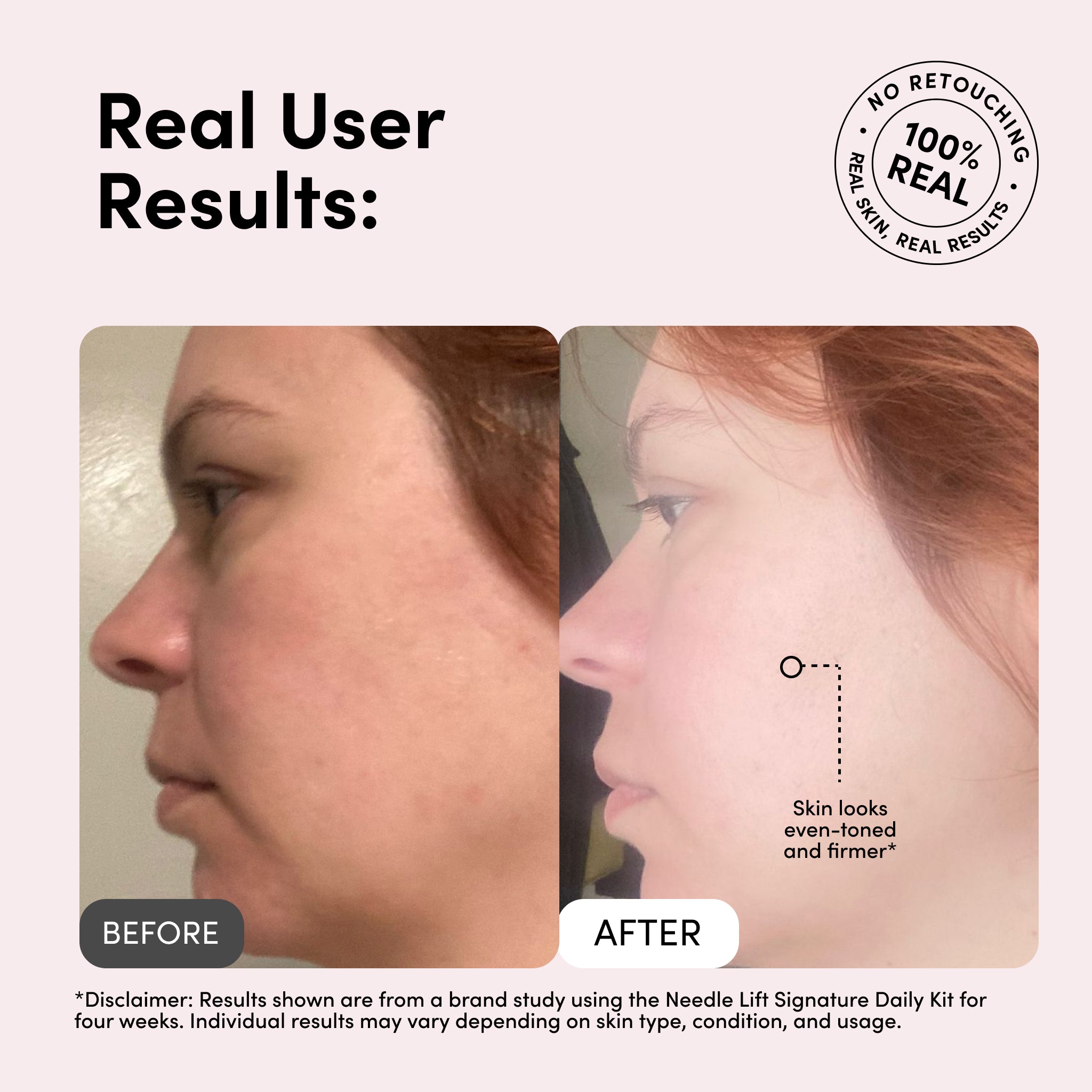 Medi Lift – Needle Lift Signature Cream | Balance, Hydrate, and