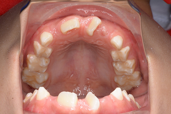 乳歯〜混合歯列期 | ひたちの矯正歯科