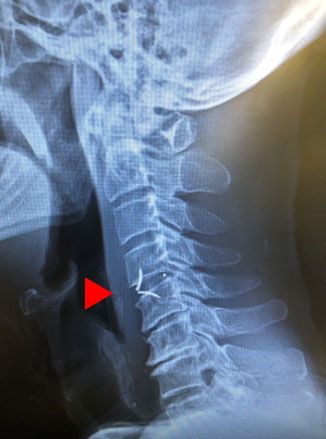 脊椎脊髄センター｜手術治療｜順天堂大学医学部附属順天堂医院