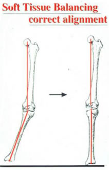 人工膝関節手術とは – かわむら整形外科