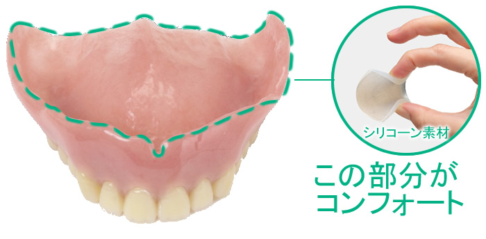 入れ歯 コンフォート義歯 ノンクラスプデンチャー 金属床 バネの無い