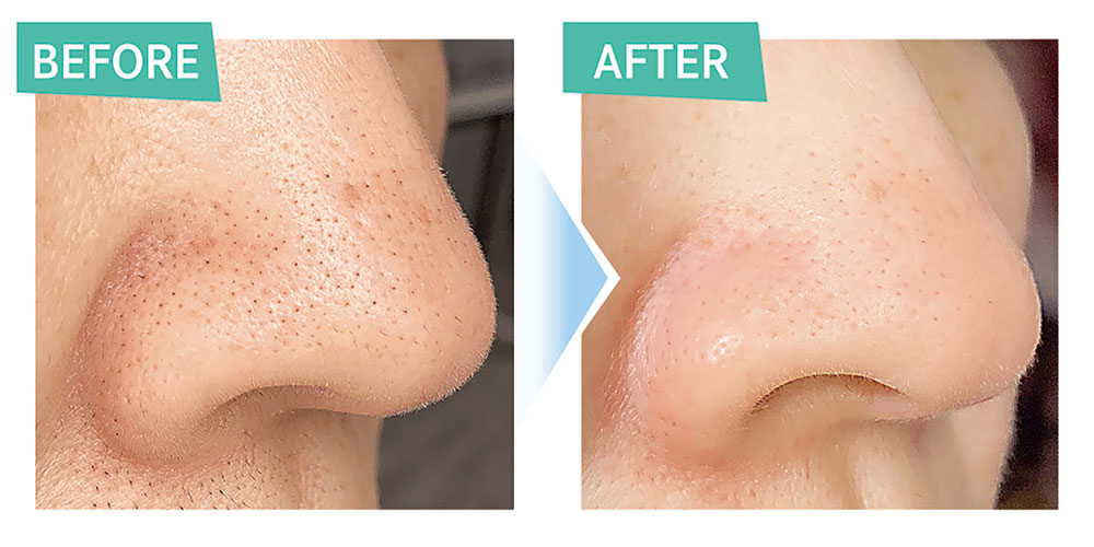 ハイドロスプラッシュ - プライベート脱毛エステサロン 龍のスミカ