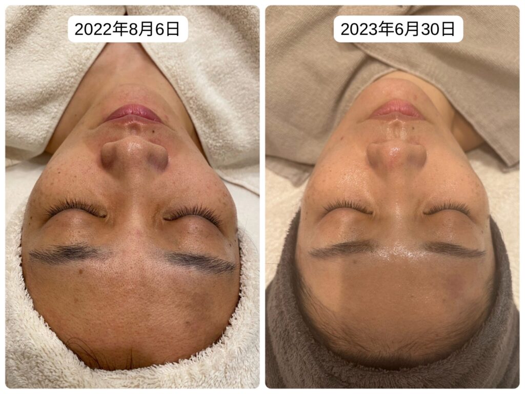 完全保存版】REVI（ルヴィ）ハーブピーリング導入ガイド｜効果・費用